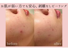 フォーウーマン(for woman)/ピーリング＋パック＋毛穴洗浄