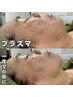 【最強の肌質改善/エイジングケア/小顔になれる】プラズマフェイシャル¥5,000