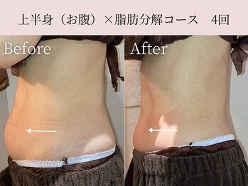 ミア(miiia)/上半身×脂肪分解コース 4回
