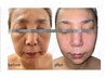 【驚く程上がる】たるみ顔最強⇒韓国サーマ300×ヒアル注入￥29800⇒￥9900