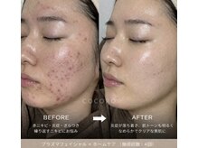 ココロ(COCORO)/ニキビケア/凹凸にはプラズマ◎