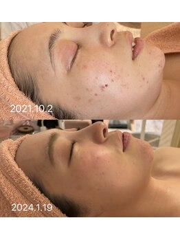 アティレ オオサカ(Attirer Osaka)/リフトアップ/小顔/美白/毛穴