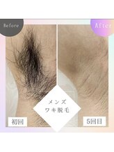 バーグトータルビューティー(bague total beauty)/ワキ脱毛