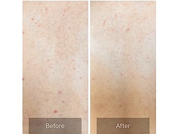 ルナート(Lunart)/ハーブピーリング【背中】