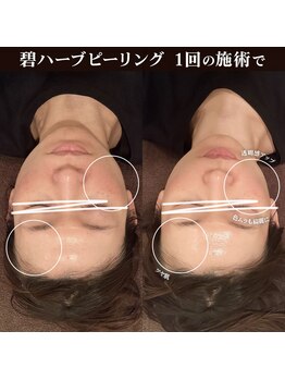 キノセ(kinose)/碧ハーブピーリング認定サロン