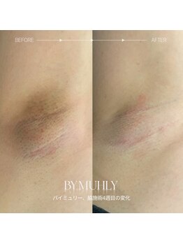 アーヒル(A”-HILU)/バイミュリー メラニンケア 脇