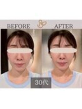 チョコバリ 錦糸町店(chocobari)/小顔×リフトアップ(美容鍼)30代