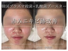 ラ ドゥーサ(La Dusa)/韓国プラズマ×乳酸菌ブースター