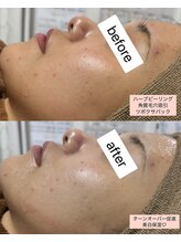 シロ(SHIRO)/ニキビ改善