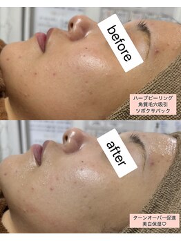 シロ(SHIRO)/ニキビ改善