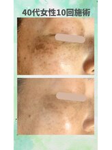 モモイロ(momoiro)/シミケア45分/コンシーラー卒業!