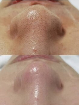 エムズビューティスタジオ エステ リラク 西川口店(M's Beauty Studio)の写真/【人気No.1毛穴洗浄コース】黒ずみ／詰まり／ザラつきスッキリ★毛穴レス肌/つるんとたまご肌へ目指せる