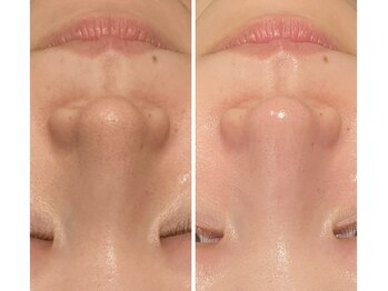 チェンジ 小山店(Change)/ハイドラフェイシャル