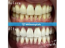 ホワイトニングカフェ 黒崎店(WhiteningCafe)の雰囲気（リクライニングチェアで施術中はリラックス♪）