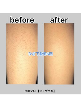 シュバル(CHEVAL)/足脱毛6回