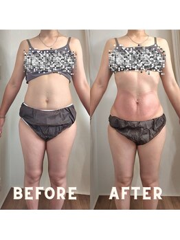 ココノワ(coconoix)/脂肪冷却&キャビテーション3回