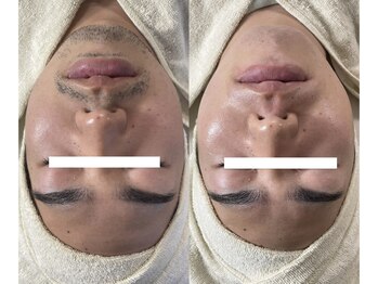 ミーミドットアイ(Mi-mi.i)/髭ワックス脱毛、髭光脱毛