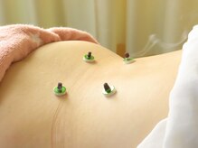 アイワ鍼灸整骨院/お灸