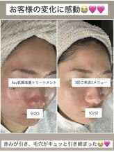 レイ(Rey)/集中ケアで感動の肌質改善！