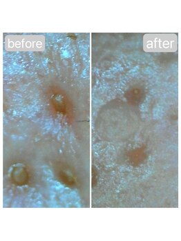 エイル ビューティ ホヌ(EIL beauty Honu)/マイクロスコープ画像