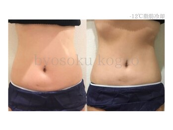 メディカルエステ 新宿南口店/*日本初-12℃脂肪冷却症例*
