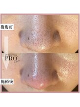 ミニョンプラス(Mignon+)/3ミリから5ミリ深い汚れ取り除く