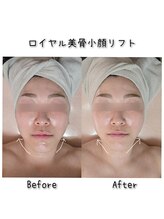 ラエッセス(A Laessess)/1回の施術でも！