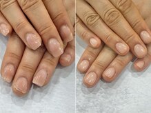 リファーレ(RIFARE)/他店修正★自然な深爪矯正♪