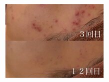 ホワイトアクア 加古川店(WHITE AQUA)/ハーブピーリングで肌荒れ改善