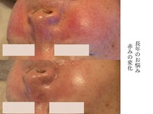 アン(An)/お肌の赤みに変化