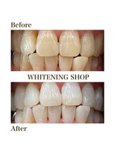 ホワイトニングショップ 安城店/【BeforeAfter】