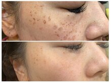 ポルトボーテ(Porte Beaute)/シミが薄くなりました