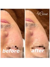 フォーケア(4Care)/超音波フェイシャル