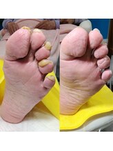ドクターネイル爪革命 長野店/【肥厚・変形爪】ネイル/フット