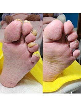 【肥厚・変形爪】ネイル/フット
