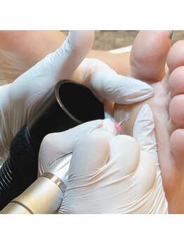 巻き爪補正店 横浜駅前店/3.魚の目がある場合取り除きます