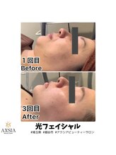 アクシア ビューティー サロン(AXSIA)/【光フェイシャル】BeforeAfter