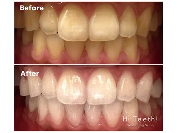 ハイティース 高田馬場店(Hi Teeth!)/医療提携セルフホワイトニング