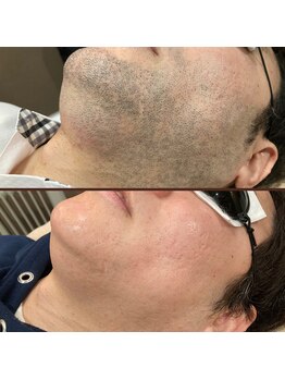 メンズキュー(Men's Cue)/脱毛8ヶ月