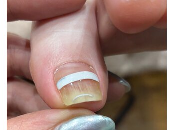 3週間集中 ドイツ式巻き爪補正