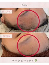 エミル(Emillu)/＊facial_ビフォーアフター