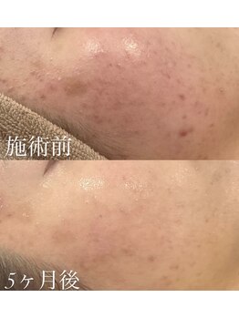 ミセル(MISEL2nd)/ニキビケア/毛穴/くすみ徹底改善