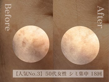 ディレイア ザ コスメ 有楽町マルイ店(direia the cosme)/シミ/くすみ/代謝促進［有楽町］