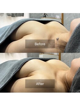 サロン リヒカ(Salon Rihica)/下垂削げ胸のお悩みにも