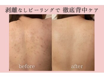 フォーウーマン(for woman)/背中ピーリング+セルサー