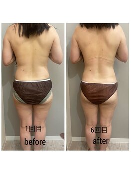 サロンシファ(salon sifa)/インディバでのダイエット