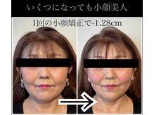 ユウサク(Yusaku)/50代症例【小顔矯正/本町/梅田】