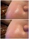 サロンドリマ(Salon de Lima)の写真/【本気で毛穴レスを望む方へ】本気で毛穴引き締めとリフトアップで最新医療提携マシンで理想の肌andお顔に!