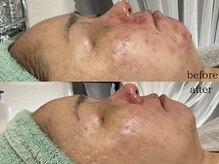 ステラ(Stella)/皮膚科で改善しなかったニキビに