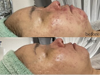 ステラ(Stella)/皮膚科で改善しなかったニキビに